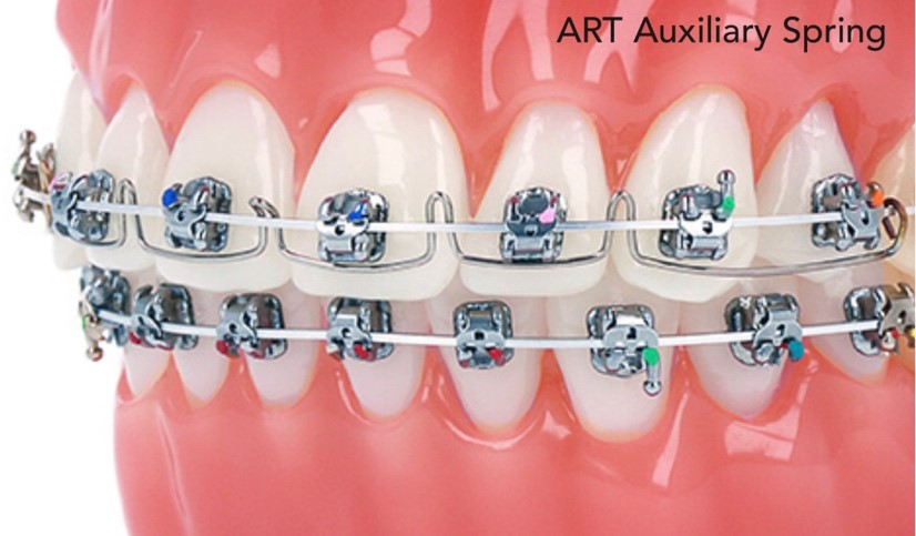 Lò xo Anterior Root Torquing (ART) - Ảnh 2