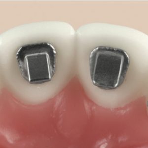 Alternative view of Nút chặn mặt lưỡi Bite Block (Hộp 10 chiếc)